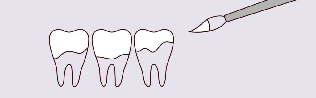 Fluoride Treatments