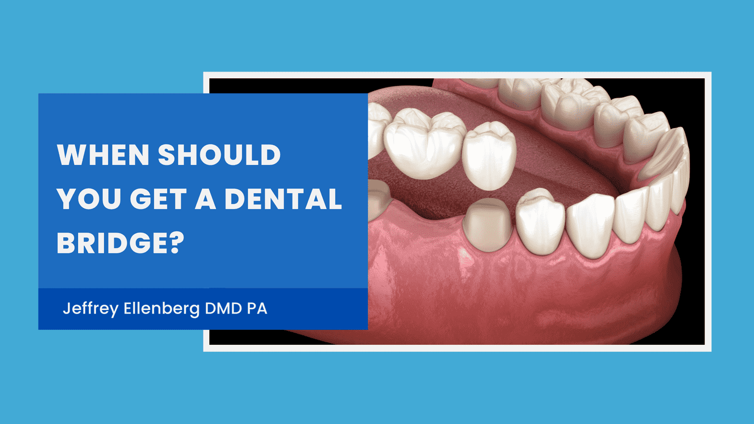 When Should You Get a Dental Bridge?