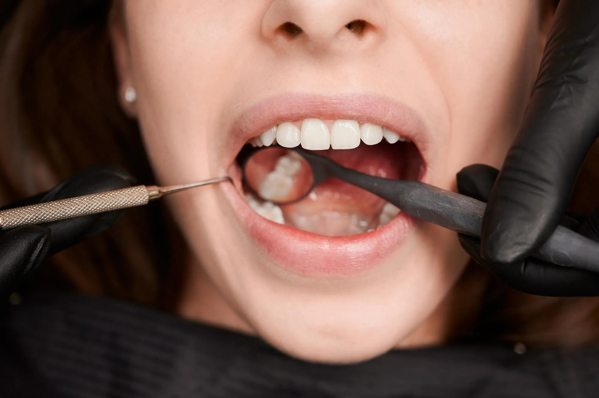 Types of Dental Fillings: Composite, Amalgam, and More